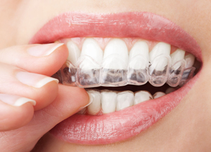 invisible-braces